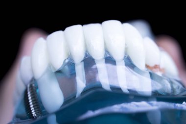 Vida diş hekimi diş diş öğretim modeli gösteren titanyum metal diş implant.