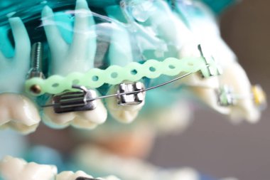 Diş metal diş teli Ortodonti modeli öğretim diş telini aligners.