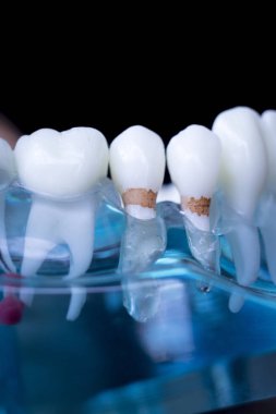 Diş hekimi diş diş modeli gösteren öğretim her diş ve dişeti hastalar ve öğrenciler için.