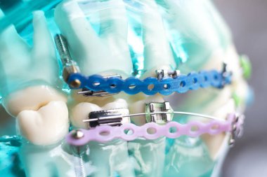 Diş metal diş teli Ortodonti modeli öğretim diş telini aligners.