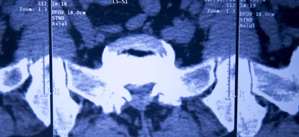 엑스레이 엉덩이 Mri — 스톡 사진