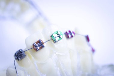 Diş metal diş teli Ortodonti modeli öğretim diş telini aligners.