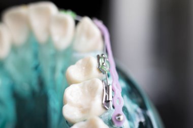 Diş metal diş teli Ortodonti modeli öğretim diş telini aligners.