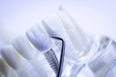 Titanyum metal diş hekimi temizlik dişler plak ve çürüme kaldırmak için araç almak.