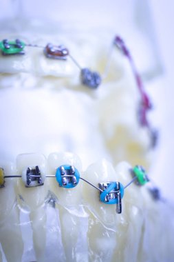 Diş metal diş teli Ortodonti modeli öğretim diş telini aligners.