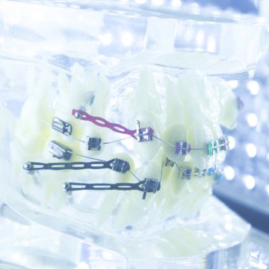 Ortodonti diş hekimleri öğretim modeli diş diş plastik ve metal köşeli parantez her diş düzleştirmek için aligners.