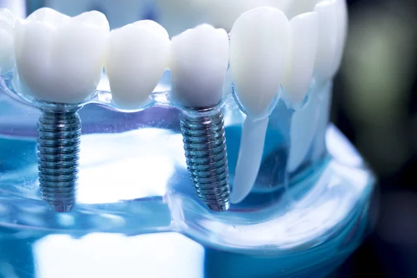 Dentista Dentes Dentários Modelo Ensino Mostrando Titânio Metal Dente Implante — Fotografia de Stock