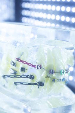 Ortodonti diş hekimleri öğretim modeli diş diş plastik ve metal köşeli parantez her diş düzleştirmek için aligners.