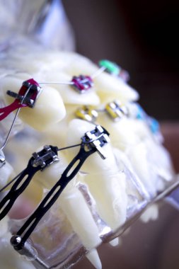 Diş metal diş teli Ortodonti modeli öğretim diş telini aligners.