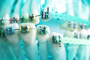 Diş metal diş teli Ortodonti modeli öğretim diş telini aligners.