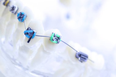Diş metal diş teli Ortodonti modeli öğretim diş telini aligners.