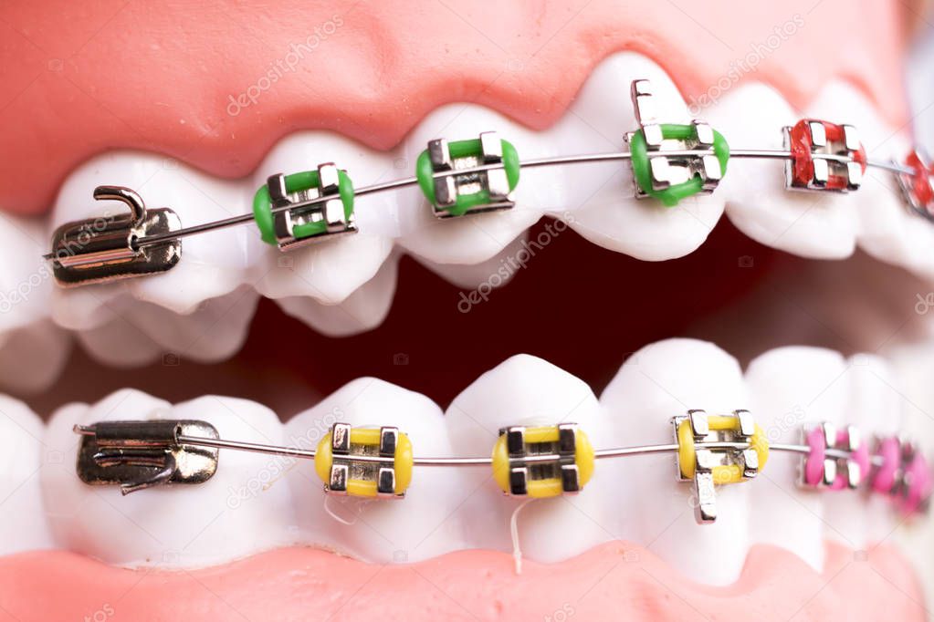 Dental metal braces teeth retainer aligners teaching orthodontics model.