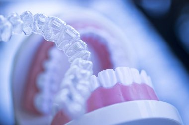 Kozmetik diş hekimliğinde hastalar için dişleri hizalamak için kullanılan görünmez diş düzenleyiciler.