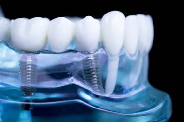 Vida diş hekimi diş diş öğretim modeli gösteren titanyum metal diş implant.