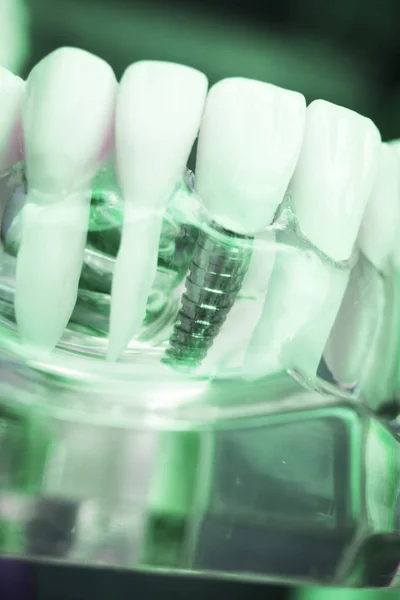 Dentista Dentale Modello Insegnamento Che Mostra Denti Titanio Metallo Vite — Foto Stock