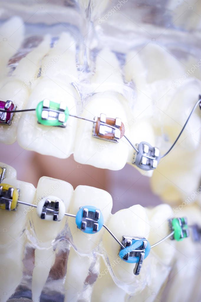 Dental metal braces teeth retainer aligners teaching orthodontics model.
