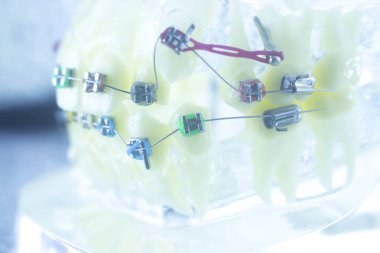 Ortodonti diş hekimleri öğretim modeli diş diş plastik ve metal köşeli parantez her diş düzleştirmek için aligners.