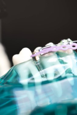 Diş metal diş teli Ortodonti modeli öğretim diş telini aligners.