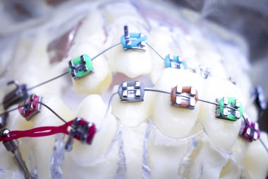 Diş metal diş teli Ortodonti modeli öğretim diş telini aligners.