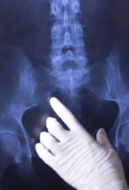 Tıbbi hastane röntgen lowe sırt ağrısı omurga ve kalça Travmatoloji tarama.