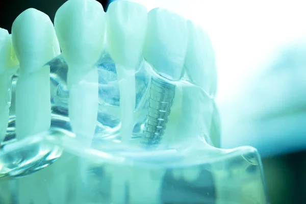 Zębów Dentystycznych Dentysta Nauczania Modelu Wyświetlone Tytanu Metalowych Zębów Implantu — Zdjęcie stockowe