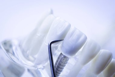 Titanyum metal diş hekimi temizlik dişler plak ve çürüme kaldırmak için araç almak.