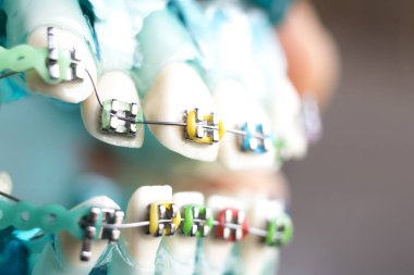 Diş metal diş teli Ortodonti modeli öğretim diş telini aligners.