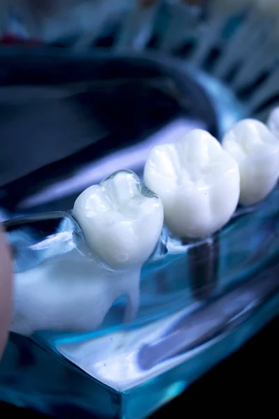Modelo Enseñanza Dientes Dentales Dentistas Que Muestran Tornillo Implante Dientes —  Fotos de Stock