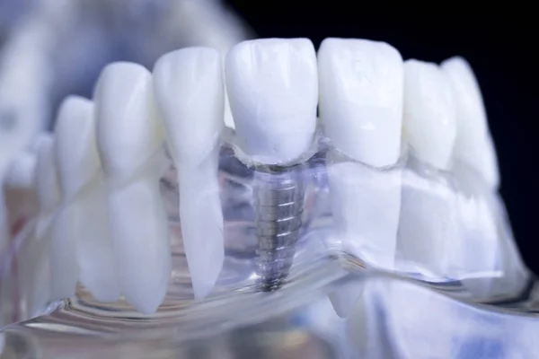 Zubař Zubní Zuby Výuka Modelu Zobrazeno Titan Kovové Zubní Implantát — Stock fotografie
