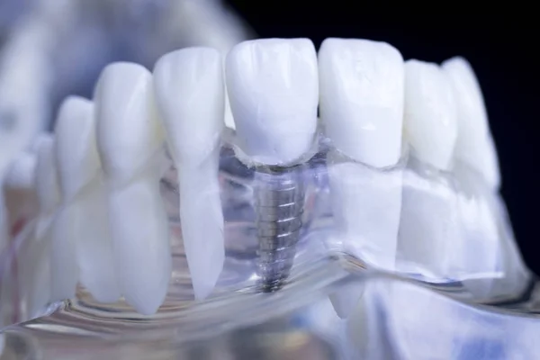 Modelo Enseñanza Dientes Dentales Dentistas Que Muestran Tornillo Implante Dientes — Foto de Stock