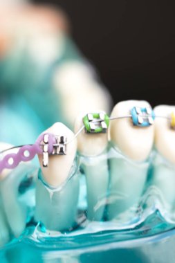 Diş metal diş teli Ortodonti modeli öğretim diş telini aligners.