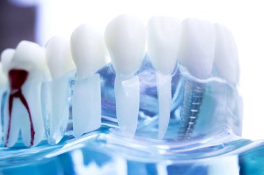 Vida diş hekimi diş diş öğretim modeli gösteren titanyum metal diş implant.