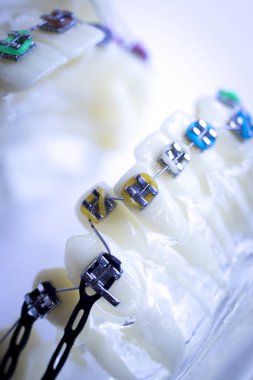 Diş metal diş teli Ortodonti modeli öğretim diş telini aligners.