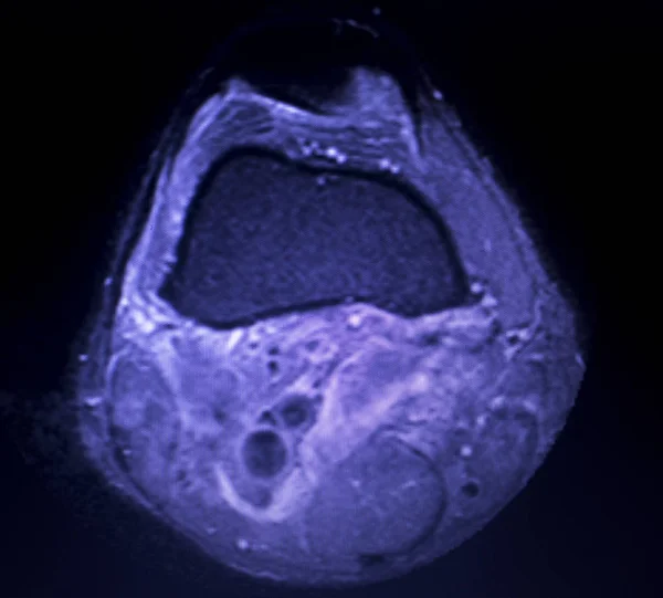 Μαγνητική Τομογραφία Mri Γόνατο Οπισθίου Κέρατος Έσω Μηνίσκου Δάκρυ Scantest — Φωτογραφία Αρχείου