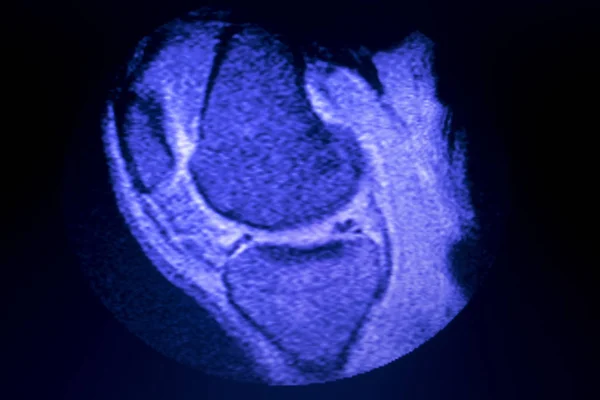 核磁気共鳴 Mri 膝後方ホーン内側半月板涙 Scantest — ストック写真
