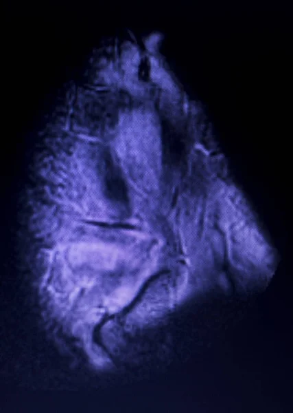Obrazowanie Rezonansu Magnetycznego Mri Kolana Tylnego Rogu Łąkotki Przyśrodkowej Łza — Zdjęcie stockowe