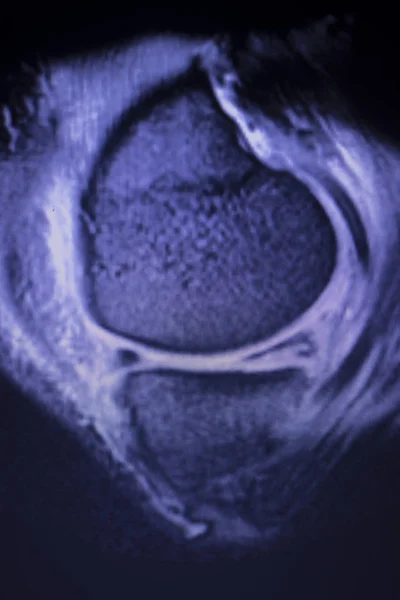 Obrazowanie Rezonansu Magnetycznego Mri Kolana Tylnego Rogu Łąkotki Przyśrodkowej Łza — Zdjęcie stockowe