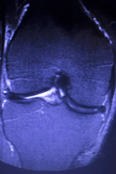 核磁気共鳴 Mri 膝後方ホーン内側半月板涙 Scantest — ストック写真