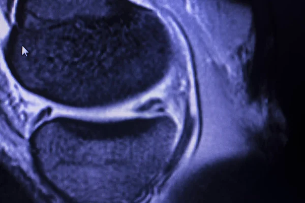 Resonancia Magnética Por Resonancia Magnética Rmn Rodilla Cuerno Posterior Menisco — Foto de Stock