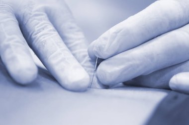 Fizyoterapi kliniği Doku İçi Perkütanöz Elektroliz EPI Kuru iğneli fizyoterapist yaralanması.