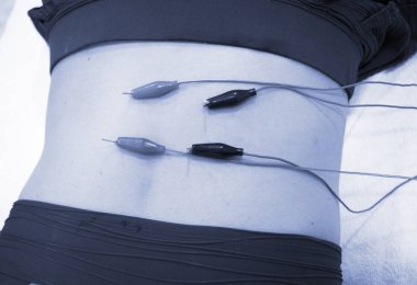 Fizyoterapi kliniği Doku İçi Perkütanöz Elektroliz EPI Kuru iğneli fizyoterapist yaralanması.