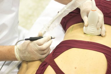 Fizyoterapi kliniği Doku İçi Perkütanöz Elektroliz EPI Kuru iğneli fizyoterapist yaralanması.