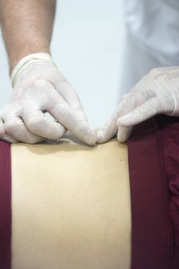 Fizyoterapi kliniği Doku İçi Perkütanöz Elektroliz EPI Kuru iğneli fizyoterapist yaralanması.