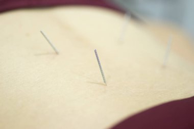 Fizyoterapi kliniği Doku İçi Perkütanöz Elektroliz EPI Kuru iğneli fizyoterapist yaralanması.
