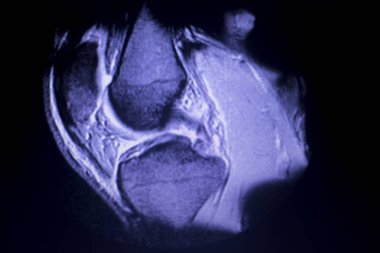 Manyetik rezonans görüntüleme MRG diz arka boynuz medial menisküs gözyaşı scantest sonuçları.