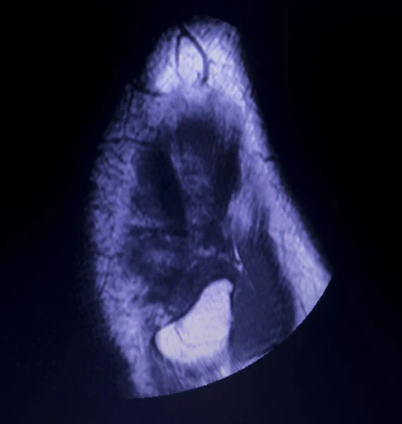 Resonancia Magnética Por Resonancia Magnética Rmn Rodilla Cuerno Posterior Menisco —  Fotos de Stock