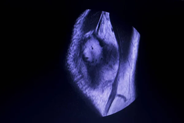 Manyetik Rezonans Görüntüleme Mrg Diz Arka Boynuz Medial Menisküs Gözyaşı — Stok fotoğraf