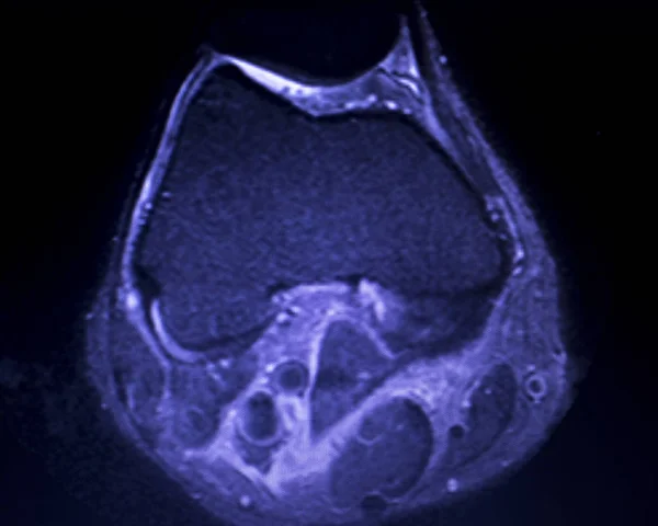 磁共振成像 Mri 膝关节后角内侧半月板撕裂扫描结果 — 图库照片