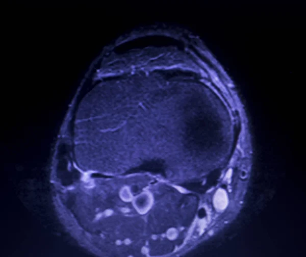 Ressonância Magnética Joelho Corno Posterior Menisco Medial Rasgo Resultados Escassos — Fotografia de Stock