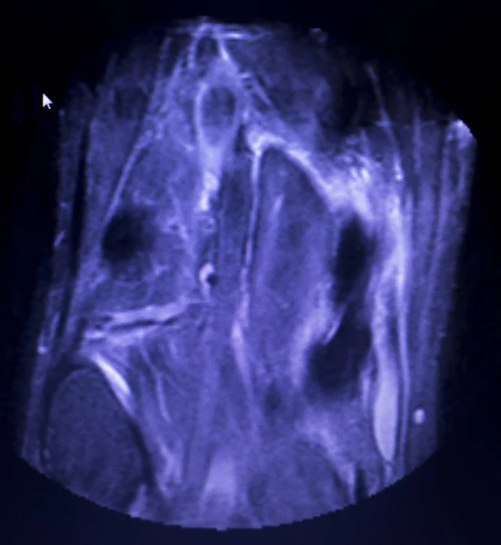 磁共振成像 Mri 膝关节后角内侧半月板撕裂扫描结果 — 图库照片